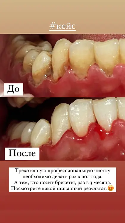 Кейс из историй клиники: профессиональная чистка, до и после